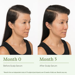 Calmi Ring - The Hair Loss Solution